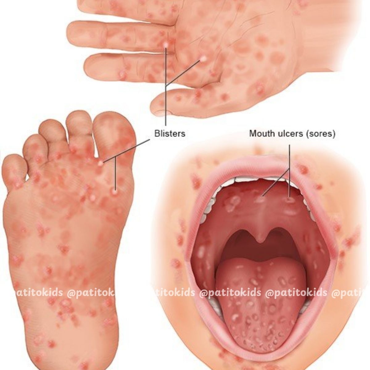 bệnh nguy hiểm ở trẻ nhỏ